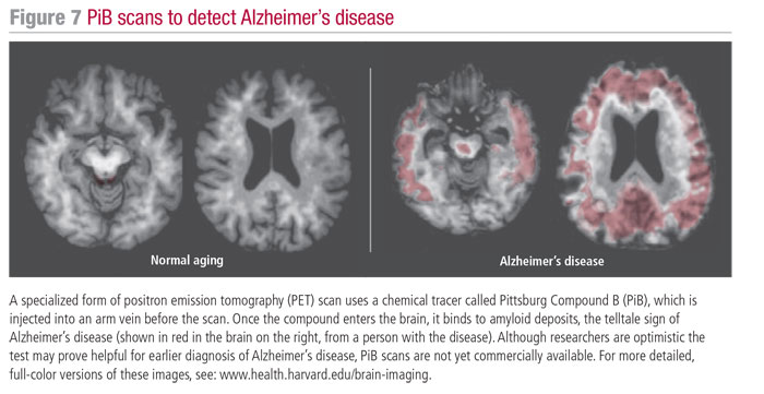 PiB scans to detect Alzheimer's disease