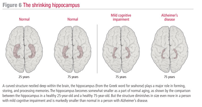 The shrinking hippocampus